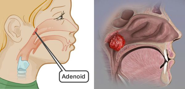 Аденоиды — причины, симптомы, диагностика и лечение аденоидов